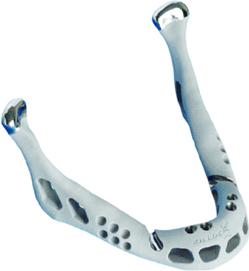Image: The 3d-printed titanium mandible (Photo courtesy of Layerwise NV). Image: The 3d-printed titanium mandible (Photo courtesy of Layerwise NV).